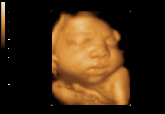 3D ultrasound image at 36 weeks